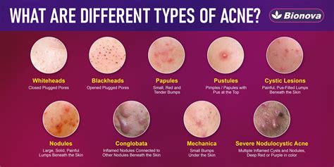 List of antibiotics for acne.  Introduction Acne is a multifactorial skin condition i...