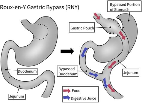 Lithium Toxicity After Roux-en-Y Gastric Bypass Surgery