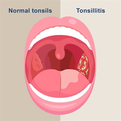 Little sister tonsils.  Learn more about tonsillitis.  The function of th...