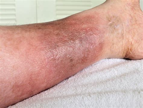 Lle cellulitis. Cellulitis is a bacterial infection of the skin spreading to the tissues under your skin. It can become serious if it’s not treated quickly with antibiotics. Cellulitis can occur on any part … 