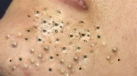 Thanks everyone#Loan_Nguyen #blackheads #acneremoval Enjoy Every Day With The Best Video Loan Nguyen 2022Enjoy Every Day With The Best Video Loan Nguyen 2022Enjoy Every Day With The Best Video Loan Nguyen 2022 The Best Product To Get Rid Of Pimple And Black Pimples Along With White Pimples. . 