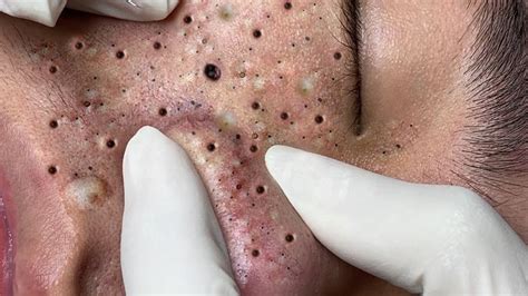 Loan Nguyen Acne Treatment specializes in posting videos about getting the biggest, most poisonous and acne-prone acne for you who like to watch squeezing acne Call / Zalo: 0905,712,220 Fanpage ....