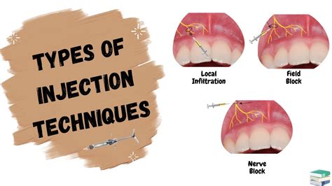 Local anaesthetic ‘nerve block’ injection for neuropathic pain