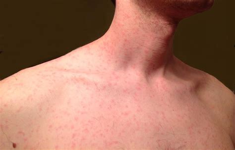 Lomatium rash. A rash that occurs in the first week of treatment, lasting for 5 days, is described as a possible side effect. Allergists should be aware of this possible adverse drug reaction when evaluating … 