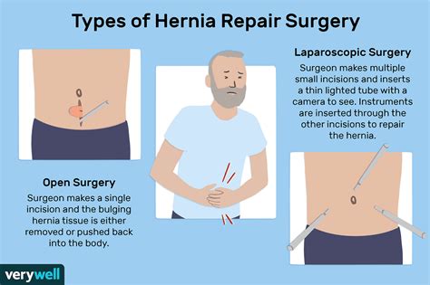 Long term side effects of hernia surgery. After hernia repair surgery, patients may experience various hernia mesh complications. The most common hernia mesh complications are persistent pain, infection, hernia recurrence, adhesion and bowel obstruction. Some patients have also reported instances of mesh failure and migration. 