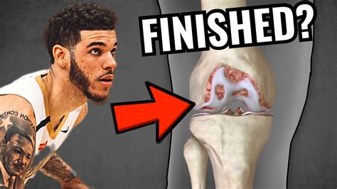 Lonzo Ball undergoes cartilage transplant in his left knee — beginning an unprecedented recovery process for the Chicago Bulls guard