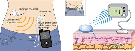 Loop: A DIY Closed-Loop Insulin Delivery System