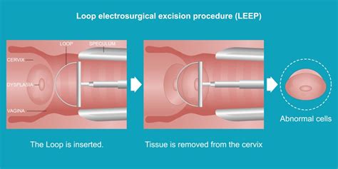 Loop Electrosurgical Excision Procedure Of Cervix