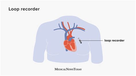 Loop recorder What it is why doctors use it and more
