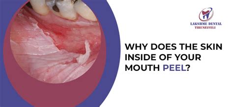 Loose skin inside mouth. .  ...
