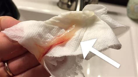Losing mucus plug after sweep. 20 Jun 2023 ... Losing Mucus Plugs at 39 Weeks · Mucus Plugs After Sweep · Mucus Plugs at ... membrane sweep on Wednesday and lost my mucus plug today. lots of .... 