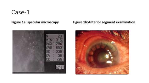 Low Endothelial Cell Count and Clear Corneal Grafts Basak SK