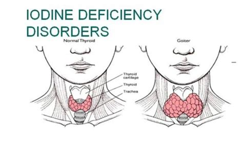 Low Thyroid and Iodine Is A BAD Idea - Triangle Thyroid Doctor