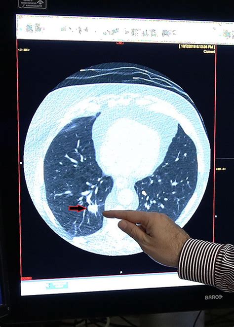 Low-Dose CT Scan for Lung Cancer Deborah Heart & Lung Center