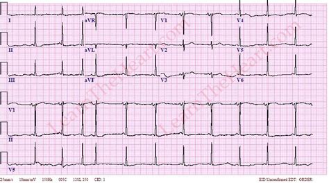 Lown-Ganong-Levine Syndrome ECG Review Learn the Heart