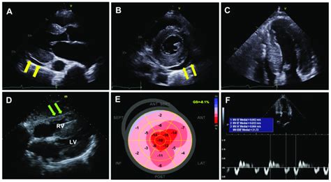 An echo test, or echocardiogram, is an ultrasound test used to view moving pictures of the heart on a screen, states WebMD. During this test, high-pitched sound waves are sent through a transducer, a device that picks up sound waves as they...