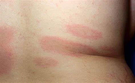Lume Rash, The three stages areearly localized, early disseminated, and  late disseminated.