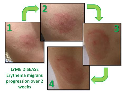 FIRST COMES IgM, THEN IgG. The pathogenesis and the different stages of infection should inform laboratory testing in Lyme disease. It is estimated that only 5% of infected ticks that bite people actually transmit their spirochetes to the human host. 5 However, once infected, the patient’s innate immune system mounts a response that …. 