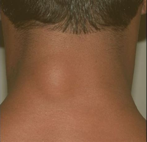 Lump on Back of Neck Right Side or Left Side: on Hair ... - Healtreatcure