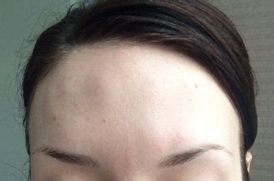 Lump on forehead after botox. .  I don&rsquo;t know what to do or if they w...