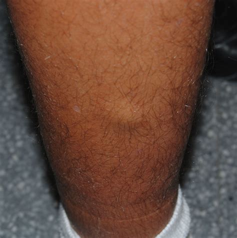 Lumps on the inner thigh. Shaving, waxing, or plucking pubic hair increases your risk of ingrown pubic hair. Ingrown hair can cause a small, round, sometimes painful, itchy bump to form. The bump may be filled with pus ... 