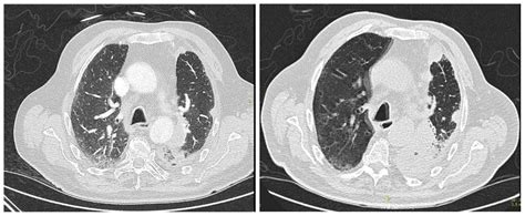 Lung Adenocarcinoma with Paraneoplastic Hyper-Eosinophilia …