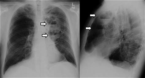 Lung Bulla - an overview ScienceDirect Topics