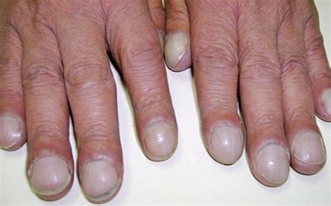 Lung Cancer May Be Developing If Your Nails Start To Look Like …