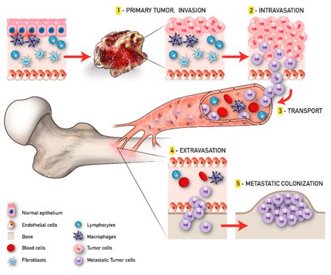 Lung Cancer Metastases to Bone: Overview and More