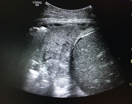 Lung consolidation on ultrasound Radiology Case