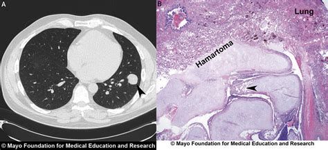 Lung nodules and MAC Mayo Clinic Connect