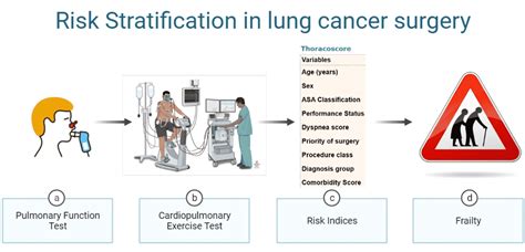 Lung perfusion imaging can risk stratify lung cancer patients for …