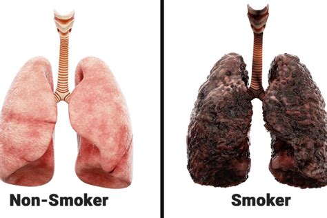 Lungs Affected By Smoking