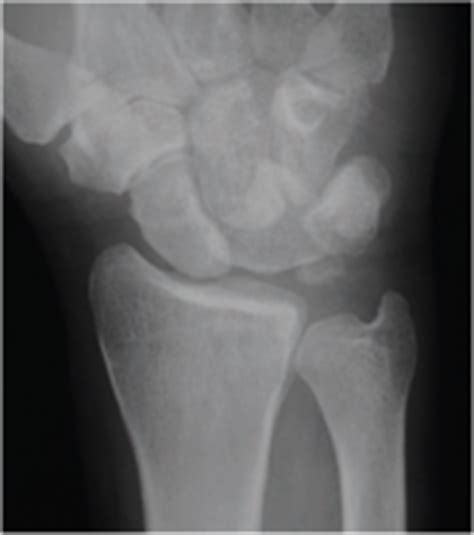 Lunotriquetral dissociation - Physiopedia