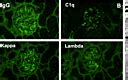 Lupus Cardiomyopathy and Nephritis Associated With …