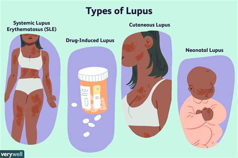 Lupus Rash on Black Skin: Symptoms, Diagnosis & Treatment