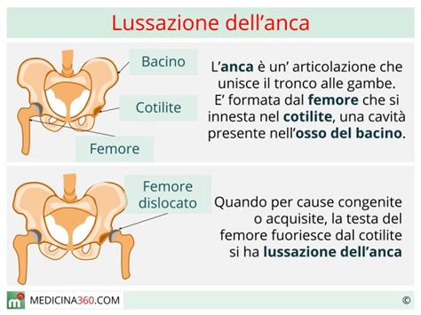 Lussazione antica traumatica iliaca del femore. - Guide catholic church non catholic explained.