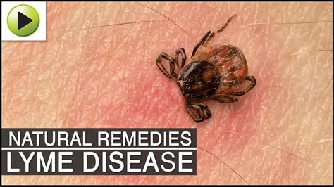 Lyme Disease Natural Treatment: Types, Research, and …