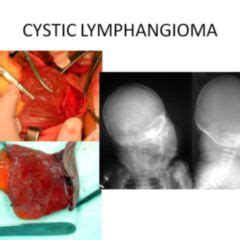 Lymphangiom - DocCheck Flexikon