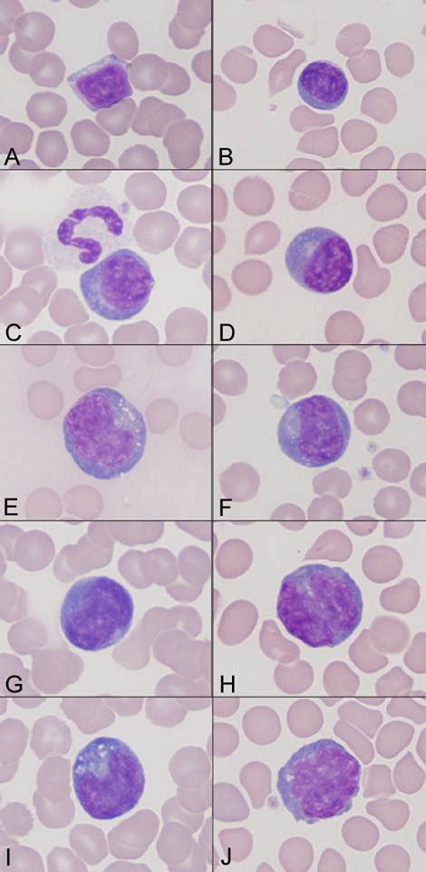 Lymphocytes Variation Medical Laboratories