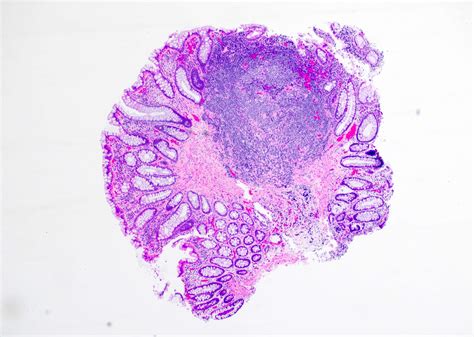 Lymphomatous polyposis of the gastrointestinal tract, including mantle cell lymphoma, follicular lymphoma and mucosa-associated lymphoid tissue lymphoma Histopathology . 2005 Nov;47(5):467-78. doi: 10.1111/j.1365-2559.2005.02225.x.
