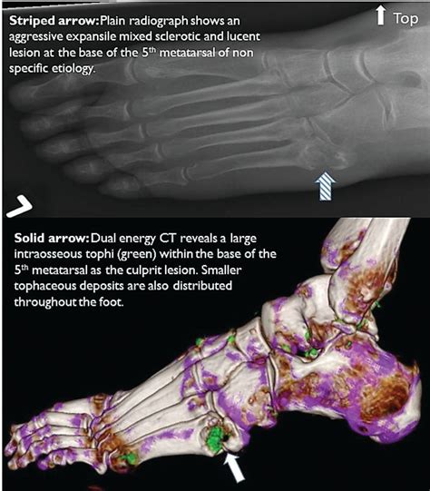 Lytic Bone Lesions: Osteomyelitis or Intraosseous Gout?