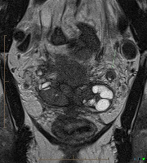 MASSIVE LOCALLY EXTENSIVE PROSTATE CANCER