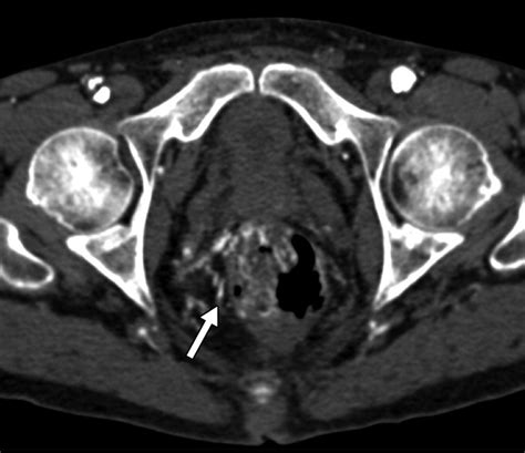 MDCT and CT Angiography Evaluation of Rectal Bleeding: The …