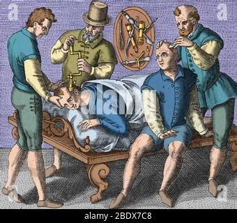 Medieval Trepanation Surgery Illustration - wintechmobiles.com