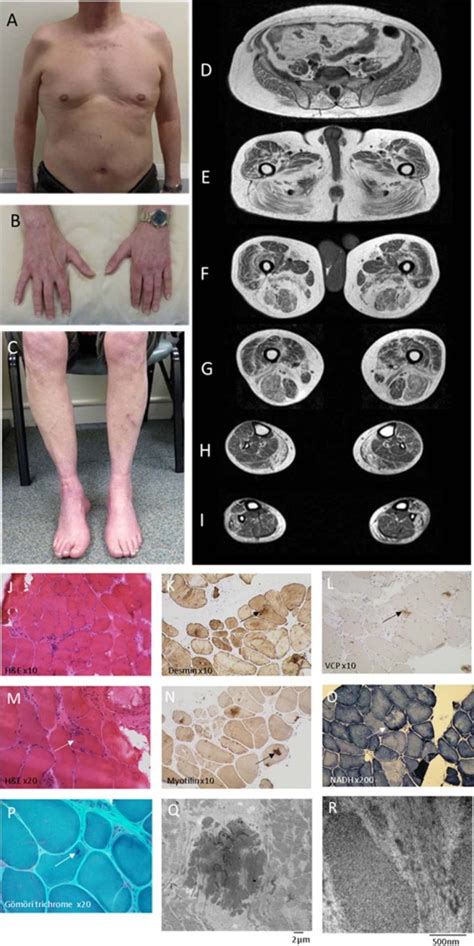 MEGF10-Related Myopathy (Concept Id: C3280679) - National …