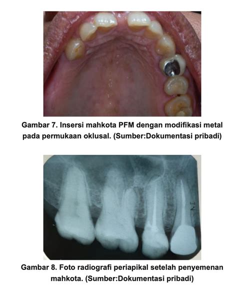 Modifikasi mahkota metal porselen pada restorasi paska perawatan ... - muktibox.com