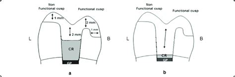 MODL onlay preparation. Download Scientific Diagram
