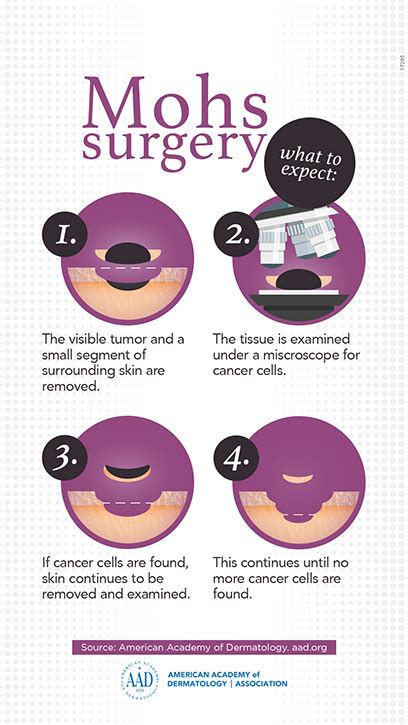 MOHS MICROGRAPHIC SURGERY - Southern Dermatology