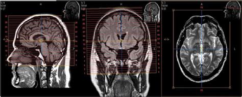 MR Brain Pre DBS - GPI Neuro Protocol OHSU